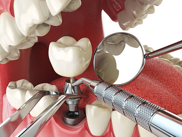 Best Emergency Root Canal Therapy in Charlevoix, MI